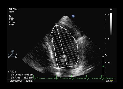 what is lvef in echocardiogram.